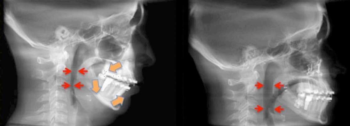 X-ray comparing recessed structure vs open airway structure