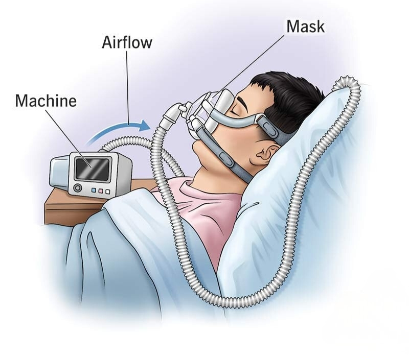 CPAP machine illustration